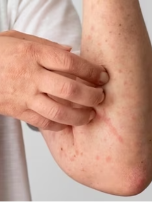 Health min raises dengue border alert level